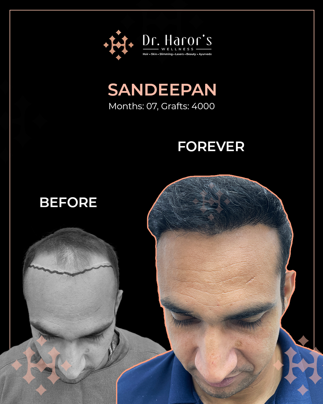 2 - Before and After